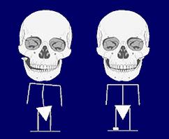 acufene