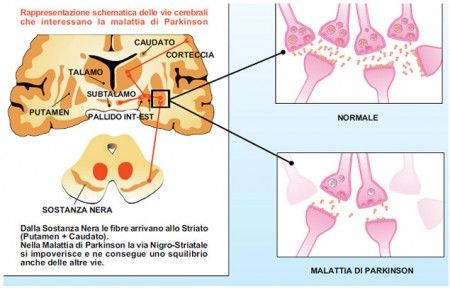 morbo di parkinson